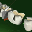 Thumb_112_tooth-desensitization