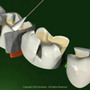 Thumb_90_tooth-desensitization