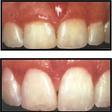 Thumb_112_gum-reduction