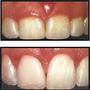 Thumb_90_gum-reduction
