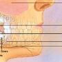 Thumb_90_wisdom-teeth-extraction