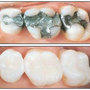 Thumb_90_teeth-fillings