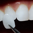 Thumb_112_veneer