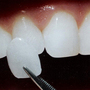 Thumb_90_veneer