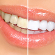Thumb_112_teeth-whitening-options-small