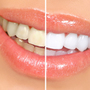 Thumb_90_teeth-whitening-options-small